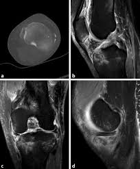 5, große rosenvene (vena saphena magna). Diagnostik Indikationen Fur Ct Und Mrt Bei Tibiaplateaufrakturen Springerlink