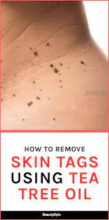 How To Remove Skin Tags With Tea Tree Oil Skin Tag Removal Skin Tag Oils For Skin