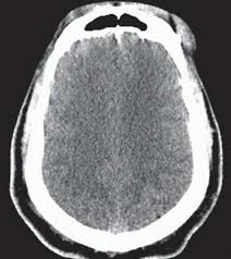 Image result for Diffuse Axonal Injury