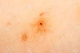 Primer Plano De Molusco Contagioso También Llamado Verruga De Agua Fotos,  retratos, imágenes y fotografía de archivo libres de derecho. Image  118862942