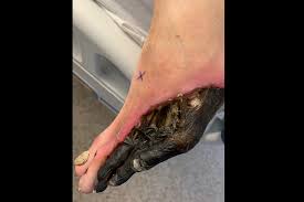 Necrosis (from ancient greek νέκρωσις, nékrōsis, death) is a form of cell injury which results in the premature death of cells in living tissue by autolysis. Ortho Dx Black Necrosis Of The Left Foot Clinical Advisor