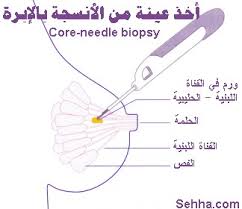 سرطان الثدي Breast Cancer منتديات جازان
