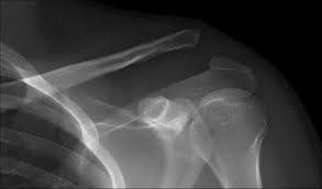 Maybe you would like to learn more about one of these? Should We Fix Grade Iii Ac Joint Injuries In Athletes