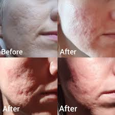 Maybe you would like to learn more about one of these? Psa I Got A Tca Cross 2 Weeks Ago My Scabs Finally Healed And Fell Off I Was Excited For The Results But I M Left With One Scar That S Far Deeper And