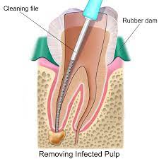 The Bad Side Of Root Canals Making An Informed Decision Celery And The City Dental Root Canal Treatment Root Canal