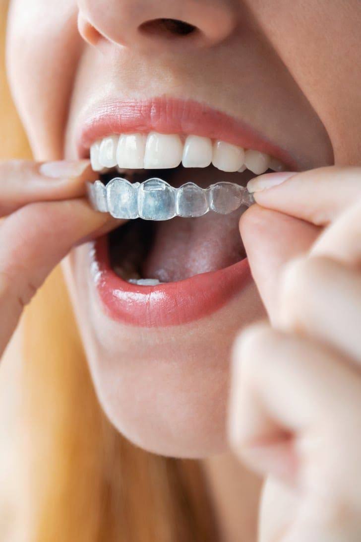 Clear Aligners product image