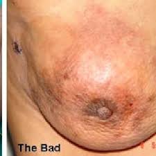 1028 3reprinted from australian family physician vol. Pdf Spectrum Of Breast Cancer In Asian Women