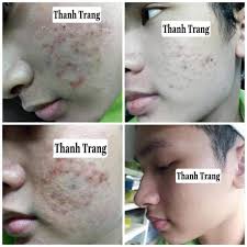 Dùng thuốc bắc tái tạo da trị mụn bao lâu thì hết mụn?