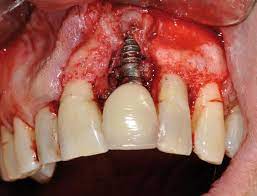 Check spelling or type a new query. 3 Symptoms Of Tooth Infection Spreading To Bloodstream Video