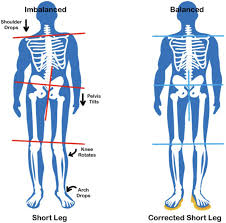 Image result for Functional Leg Length Discrepancy