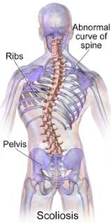 Scoliosis is an abnormal lateral curvature of the spine. Scoliosis Wikipedia