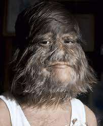 The first reported case of werewolf syndrome goes as far back as 1556. Hypertrichosis Known As Werewolf Syndrome Is A Disease Where Hair Growth On The Body Becomes Considerably Abnormal Face And Body Human Human Condition