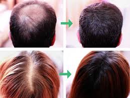 If you want better hair regrowth while preventing hair loss, then it is one of the great options that can work effectively. How To Prevent Hair Loss 9 Ways To Make It Stop Lewigs