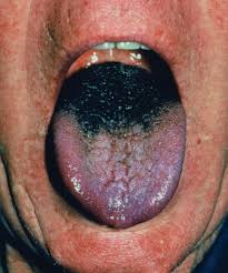Image result for black hairy tongue symptoms