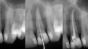 Maybe you would like to learn more about one of these? Root Canal Phoenix Restorative Dentist Phoenix Smile Fitness Dental Center