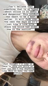 10 ways to get rid of bruises. The Risks Of Blackhead Vacuums Red Bruising And Scars