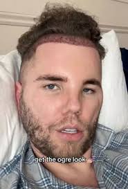 I'm A Celeb star Dean McCullough's four-figure hair transplant before  jungle adventure