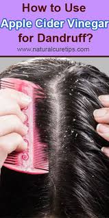 How To Use Apple Cider Vinegar For Dandruff Home Remedies For Dandruff Apple Cider Vinegar For Hair Vinegar For Hair