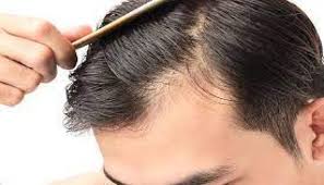 Poisons that can cause hair loss include arsenic, thallium, mercury, and lithium. 5 Ways To Stop Hair Fall In Teenage Boys