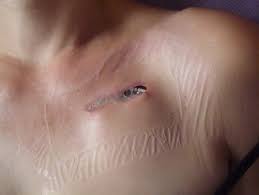 Start studying pacemakers & icds. Early Complications After Pacemaker Implantations Intechopen