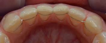 Vivera retainers can cost up to $1,000, but that's because you have to purchase a set of four. Ca Digital Memotain