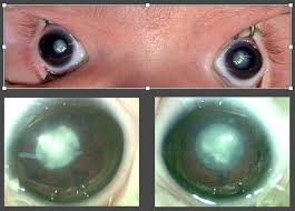 Image result for Cataract Extraction