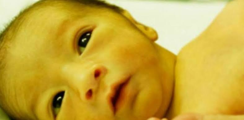Image result for Penyakit Kuning Pada Bayi"