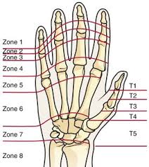 The tendons located on top of the fingers straighten the fingers while the ones located on the palm side play a role in bending the fingers. Extensor And Flexor Tendon Injuries In The Hand Wrist And Foot Clinical Gate