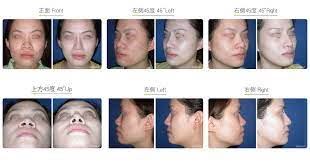 Make sure your fingers move in a circular motion. Bulbous Nose Correction Wish Aesthetic Surgery Clinic