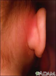Image result for Mastoiditis