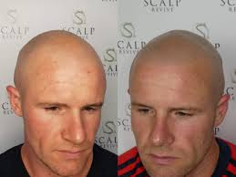 Hair loss treatments in 2021: Scalp Micropigmentation In Leeds West Yorkshire Uk