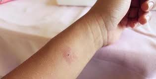 Retirer délicatement le dard puis nettoyer la zone avec un antiseptique avant d'appliquer une crème calmante. 33 Remedes Incroyablement Efficaces Pour Apaiser Une Piqure De Moustique Bug Bites Remedies Home Remedies For Bug Bites Health Myths