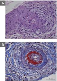 Image result for Microscopic Polyangiitis