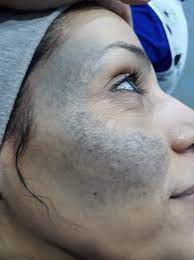Nevus Of Ota Wikipedia