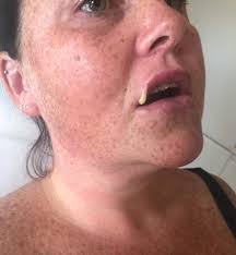 My lips exploded with pus after £60 botched fillers pierced a blood vessel  and left me permanently disfigured