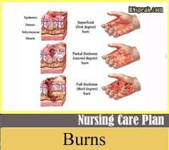 Burns Nursing Care Plan Risk For Fluid Volume Deficit Burns Treatment Burn Injury Burns Nursing