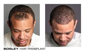 Basically, there are two (2) primary methods in obtaining hair follicles through transplantation. Bosley Hair Transplant Amp Restoration 96 Photos 70 Reviews Hair Loss Centers 9100 Wilshire Blvd Beverly Hills Ca Phone Number Yelp