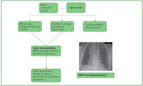 Typical pneumonia manifests with sudden onset of malaise, fever, and a productive cough. Mrsa Necrotizing Pneumonia And Peripheral Septic Thrombophlebitis Consultant360