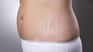 Laser stretch mark removal & skin tightening. Post Pregnancy Complications Stretch Mark Removal And Vaginal Rejuvenation