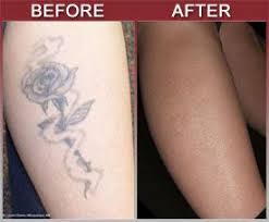 This is the most common and popular way to remove a permanent tattoo. Get Rid Tattoo Natural Tattoo Removal Solution Http Tattoo Qm50hycs Canitrustthis Com Diy Tattoo Permanent Laser Tattoo Natural Tattoo Removal