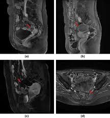 A physical examination of a woman's. Mri Can Be Used To Differentiate Between Primary Fallopian Tube Carcinoma And Epithelial Ovarian Cancer Clinical Radiology