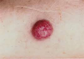 Merkel cell carcinoma typically affects older adults and the tumour usually starts in a sun exposed area such as the head or neck. Frontiers Hematological Toxicity During Concomitant Treatment With Ruxolitinib And Avelumab For Merkel Cell Carcinoma Oncology