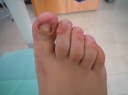 Image result for Onychogryphosis feet