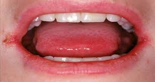 Cracked Corners Of The Mouth How To Treat Them Sore In Mouth Remedies Mouth Sores Cure For Chapped Lips