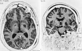 Image result for Pallidotomy