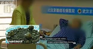 Fungsi lemon ialah untuk menumpulkan batu karang supaya tak mencederakan organ dalaman semasa proses keluar dari tubuh badan. Gempar Gara Gara Gemar Daging Berlemak Doktor Temui 800 Batu Karang Hempedu Dalam Tubuh Wanita Ini Nona