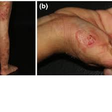 Pdf Prevalence And Age Distribution Of Pemphigus And Pemphigoid Diseases Among Pediatric Patients In Germany
