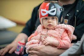 Treating Flat Head Syndrome With A Helmet Hamilton Health Sciences