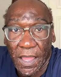 This Whole Hair Was Stuck Under My Eyelid and Wrapped Around My Eye