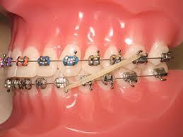 I always tell my patients elastics are an all or nothing deal. Rubber Bands Archives Lisa Kochis Orthodontics